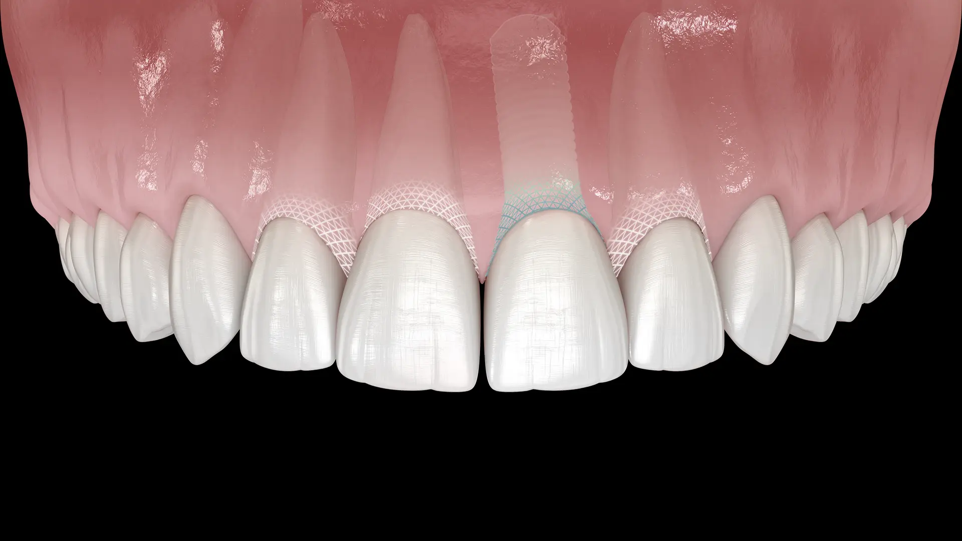 Symbionic Teeth: Zahnersatz mit einer mukosalen Schutzbarriere