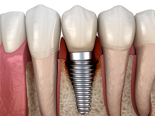 Peri-implantitis: Primarily associated with titanium implants