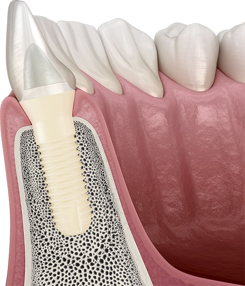 Periimplantitis verhindern mit Keramikimplantaten - Zahnimplantat System von Patent