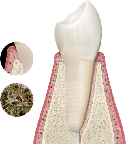 Innerhalb weniger Minuten nach der Insertion ermöglicht, erreichen Patent™ Implantate eine vollständige Bio-Integration.