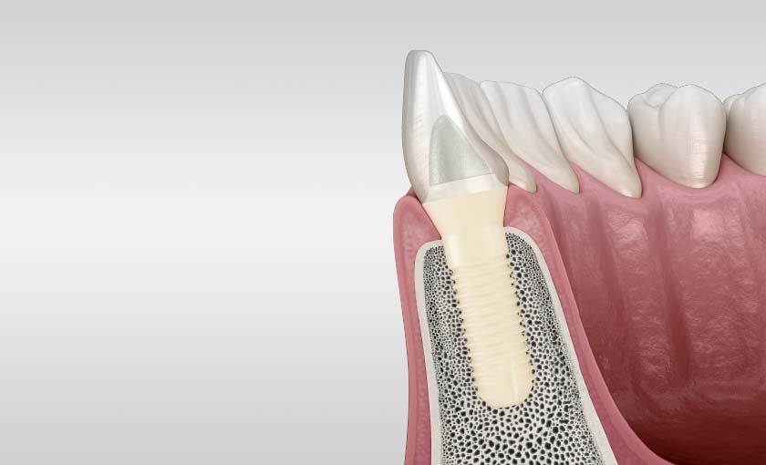 Patent Dental Implant System - leading manufacturer or zirconia implants, ceramic implants