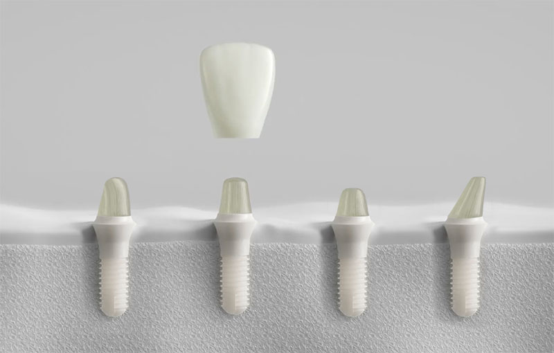 Patent Zirconia Dental Implant system with innovative prosthetic concept - completeley customizable post