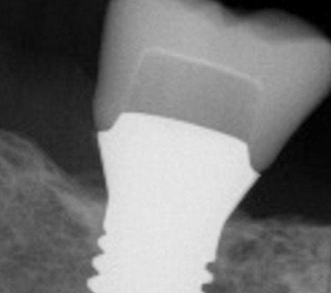 Zircon dental implants from Patent - long-term stable bone levels