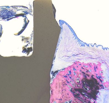 Patent ceramic implant system for long-term healthy soft tissues