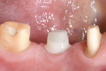 Clarico-3 Columns Style 2