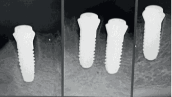 Clarico-3 Columns Style 2